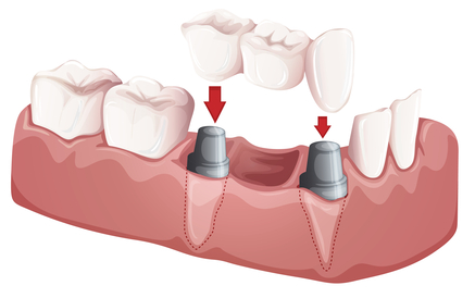dental implants w fixed bridge