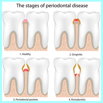 periodontal disease progression chart
