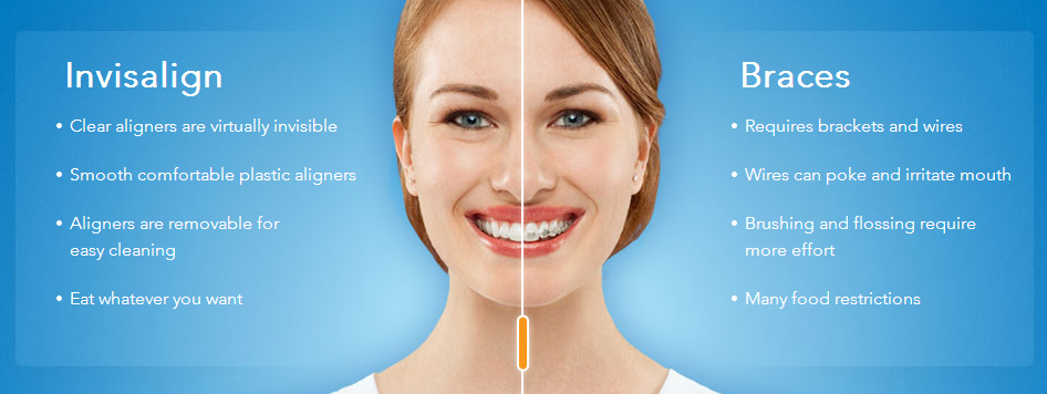 Invisalign | Straight Teeth Braces | San Diego, CA