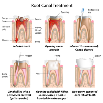 Root Canal: The Controversy (Podcast)